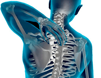 a manifestation of osteochondrosis of the chest spine