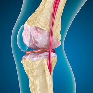 Excessive tension of the thigh muscle causes the knee pain