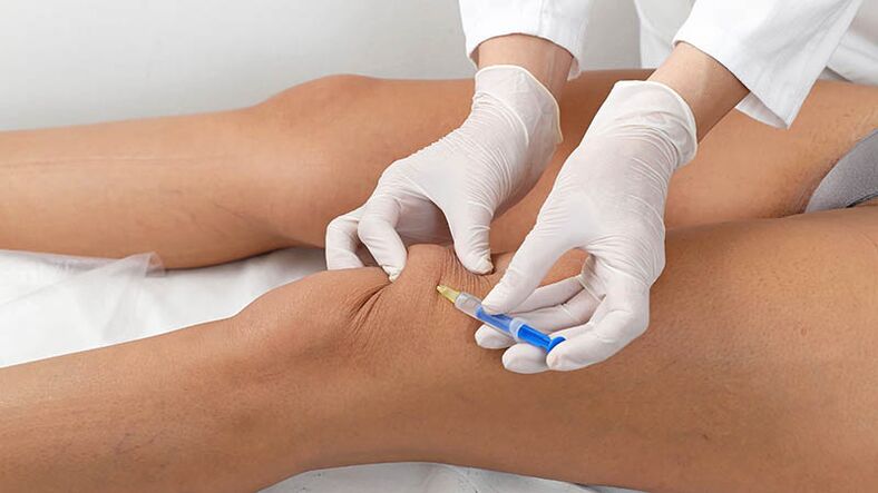 Intraarticular injection for knee arthrosis