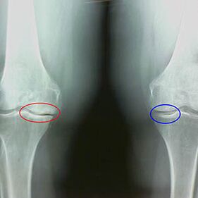 The knee joint arthrosis on the X -ray