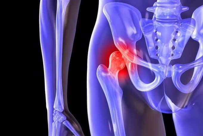 Pathological process in the hip joint in coxarthrosis